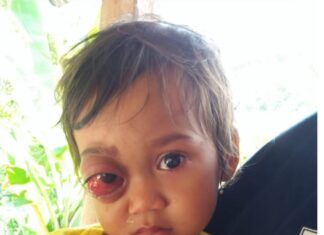 Balita Toraja terkena tumor mata